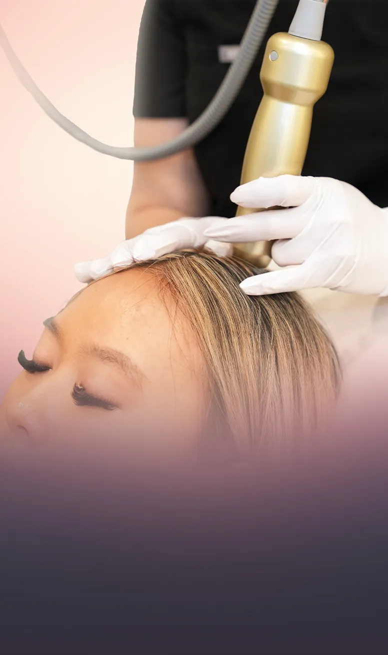 Sylfirm X RF Microneedling for Scalp treatment at Toronto medical spa - Sylfirm X strengthens follicles and improves absor...